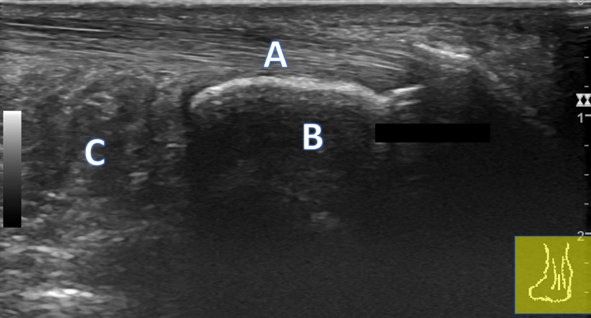 Posterior Ankle