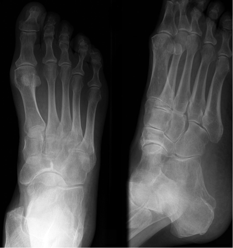 Stepping into Understanding: Navigating the World of Navicular Stress Fractures
