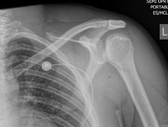 Back Up The Shoulder