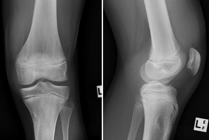 Don't Forget About the (Tibial) Spine