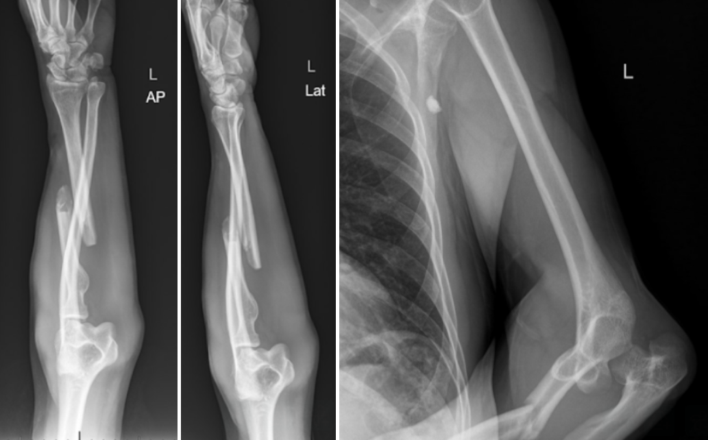 El-bow Out of This One