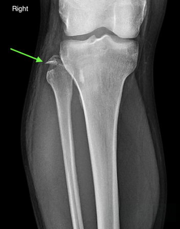 Fracture Keeps Hurting