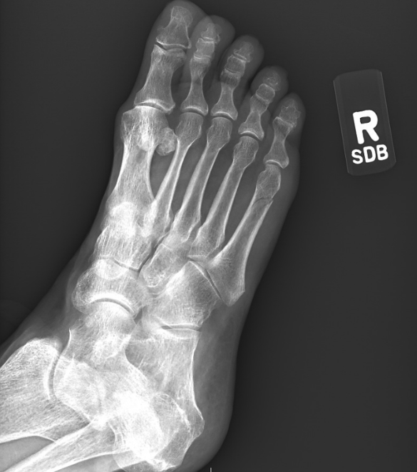 Metatarsal Madness