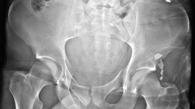 Pelvic Injury