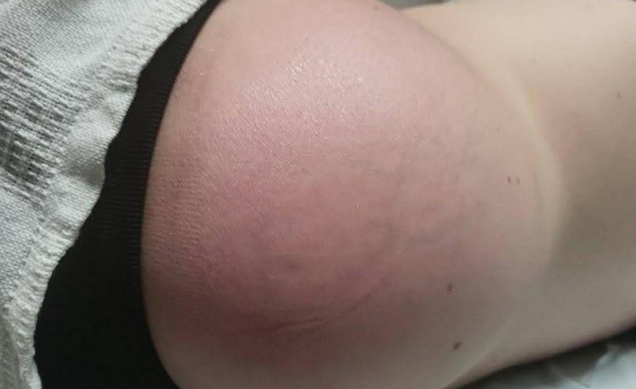 The Swelling That Would Not Go Away