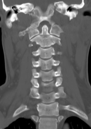 The Tooth of the Cervical Spine