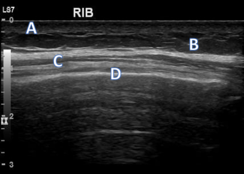 Thorax/Rib