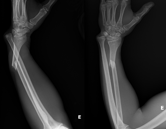 Twisting Tales: Unraveling the Complexities of the Galeazzi Fracture
