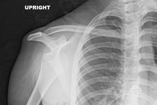 anteriorshoulderdislocation-hillsachs-mark-hopkinsD7D0C9CF-6812-6654-A361-28E4202A727C.jpg