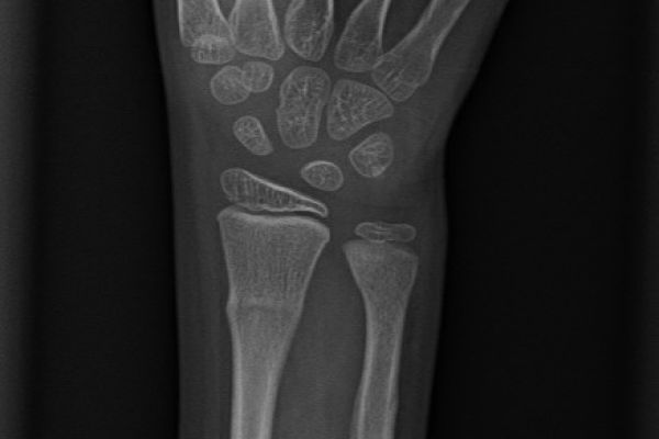 bucklefractures-mark-hopkins6F0003EF-6773-9D23-C464-0689B0CC7168.jpg