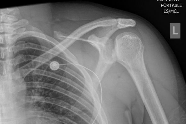 posteriorshoulderdislocation-bankarthillsachs-mark-hopkinsB8CFF9C0-C643-6F38-6D5A-33CFE4A339C4.jpg
