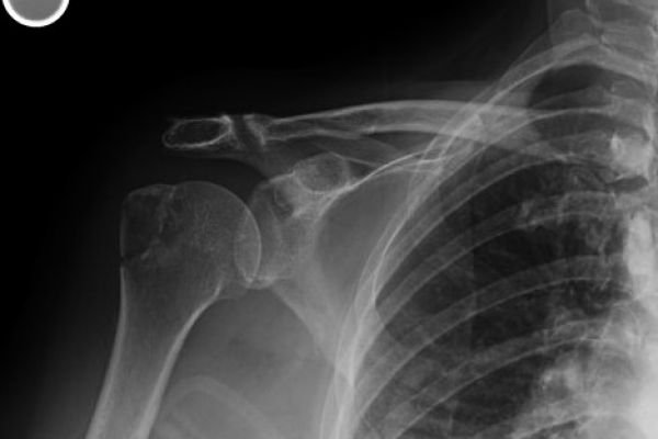 shoulder-dislocation-3-weeks-post-injury-mark-hopkinsA0C95DC1-C871-128B-16F1-4D5A2513DAE2.jpg