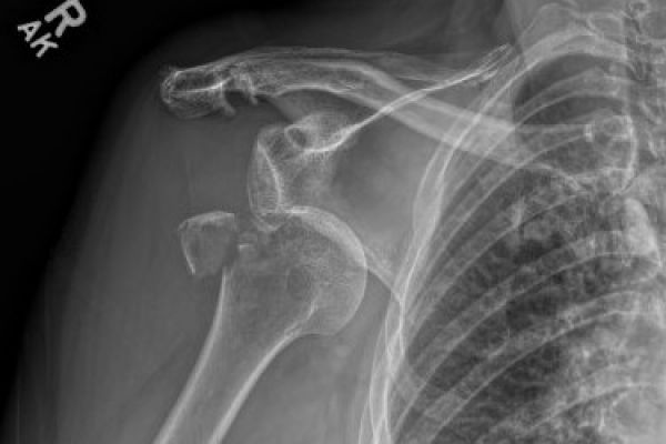 shoulderdislocation-greatertuberosityfx-mark-hopkins443E72ED-E0DF-3F7A-BDDF-D8A75531CFB4.jpg