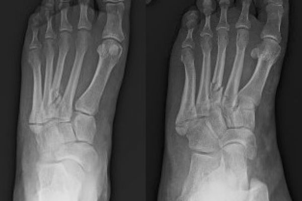 2nd-5th-metatarsal-fx-mark-hopkins890D6C0B-D4F4-E2C4-3A83-0F278176A1B5.jpg
