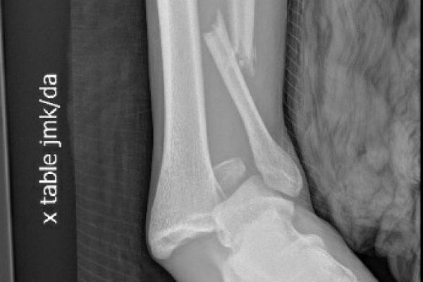 ankledislocation-mark-hopkins102FC702-D619-8141-9440-00E18F22E449.jpg