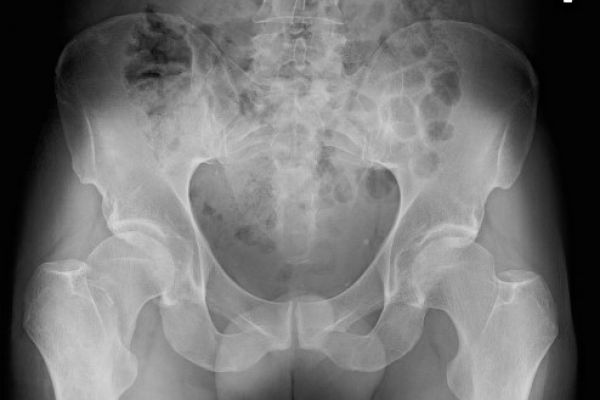 femoral-neck-fx-ap-pelvis-mark-hopkinsD20F2B8E-C766-D058-D1AD-3FD57A3F392A.jpg
