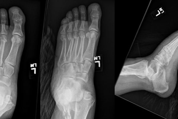 lisfranc-2to5metatarsalneck-ankledislocation-mark-hopkins6B5E81EB-BCC9-D269-BE00-20AAC94641B5.jpg