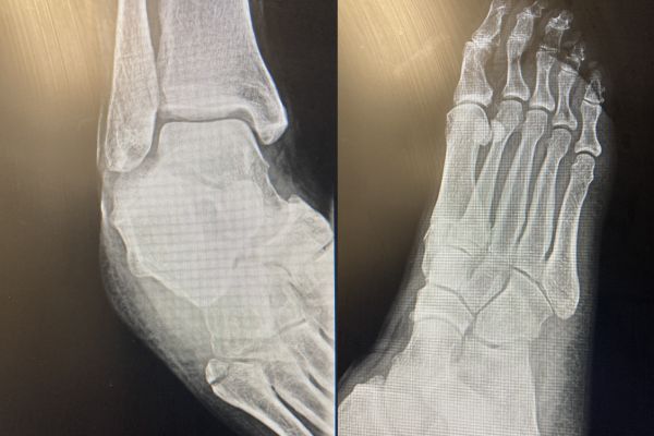 pseudojonesfracture-mark-hopkinsBA90FB35-63B8-B6B4-6F19-861DFA8EE9D6.jpg