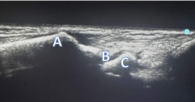 Dorsal Wrist