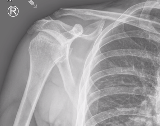 Glenn Hurt His Shoulder