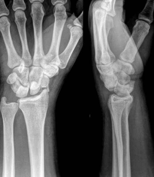 Show me your middle finger.. I can’t - it’s numb